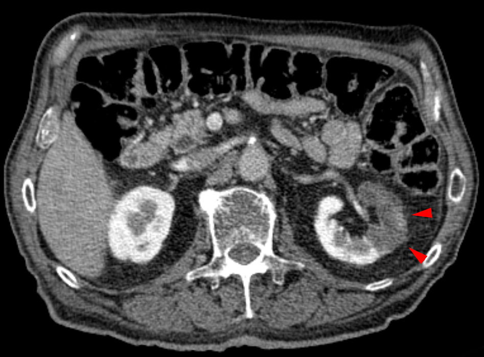 Contrast CT demonstrating a wedge-shaped hypoenhancing region in the left kidney consistent with renal infarction.