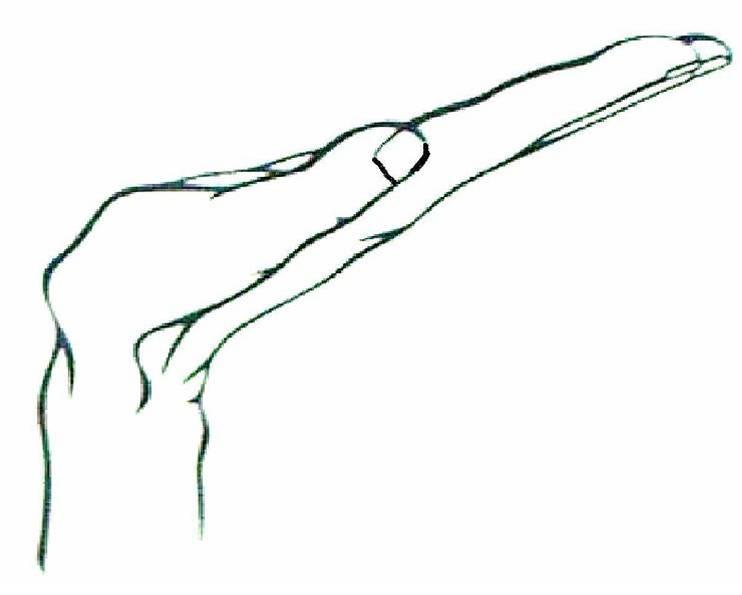 Illustration showing both wrists held in sustained flexion for the Phalen manoeuvre.