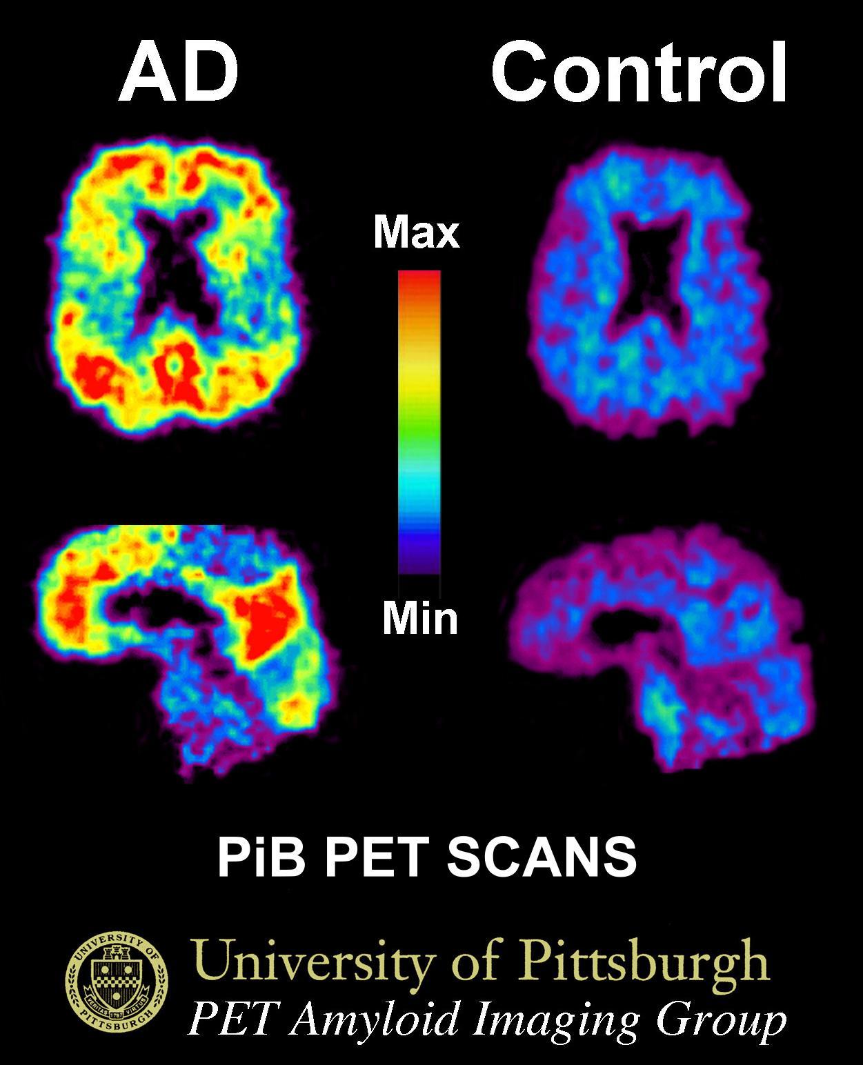 PiB amyloid PET comparison showing greater cortical tracer retention in Alzheimer disease on the left than in a cognitively normal older adult on the right.