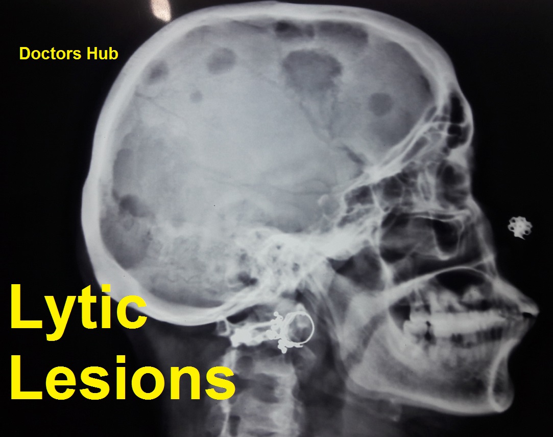 Lateral skull radiograph containing numerous discrete punched-out osteolytic lesions.