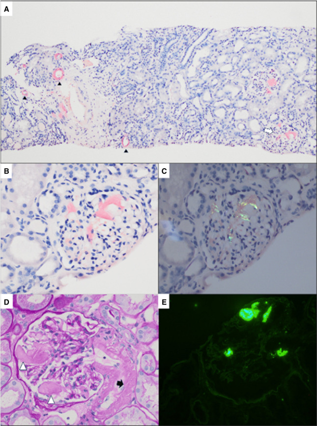 Multi-panel renal biopsy demonstrating Congo red-positive AA amyloid deposits, apple-green birefringence, AA immunostaining and amyloid fibrils.