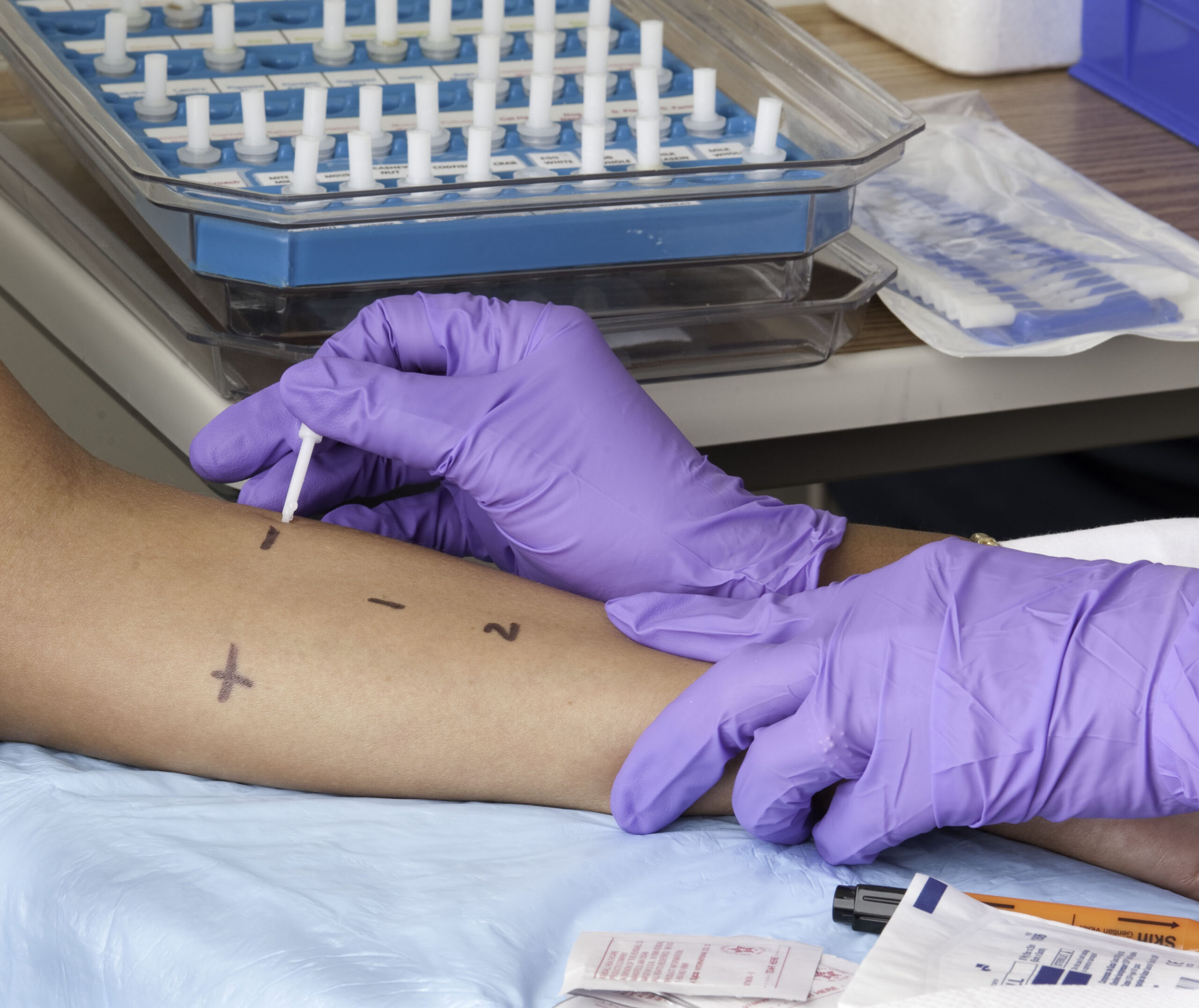 Clinician performing skin-prick allergy testing on a patient’s forearm.