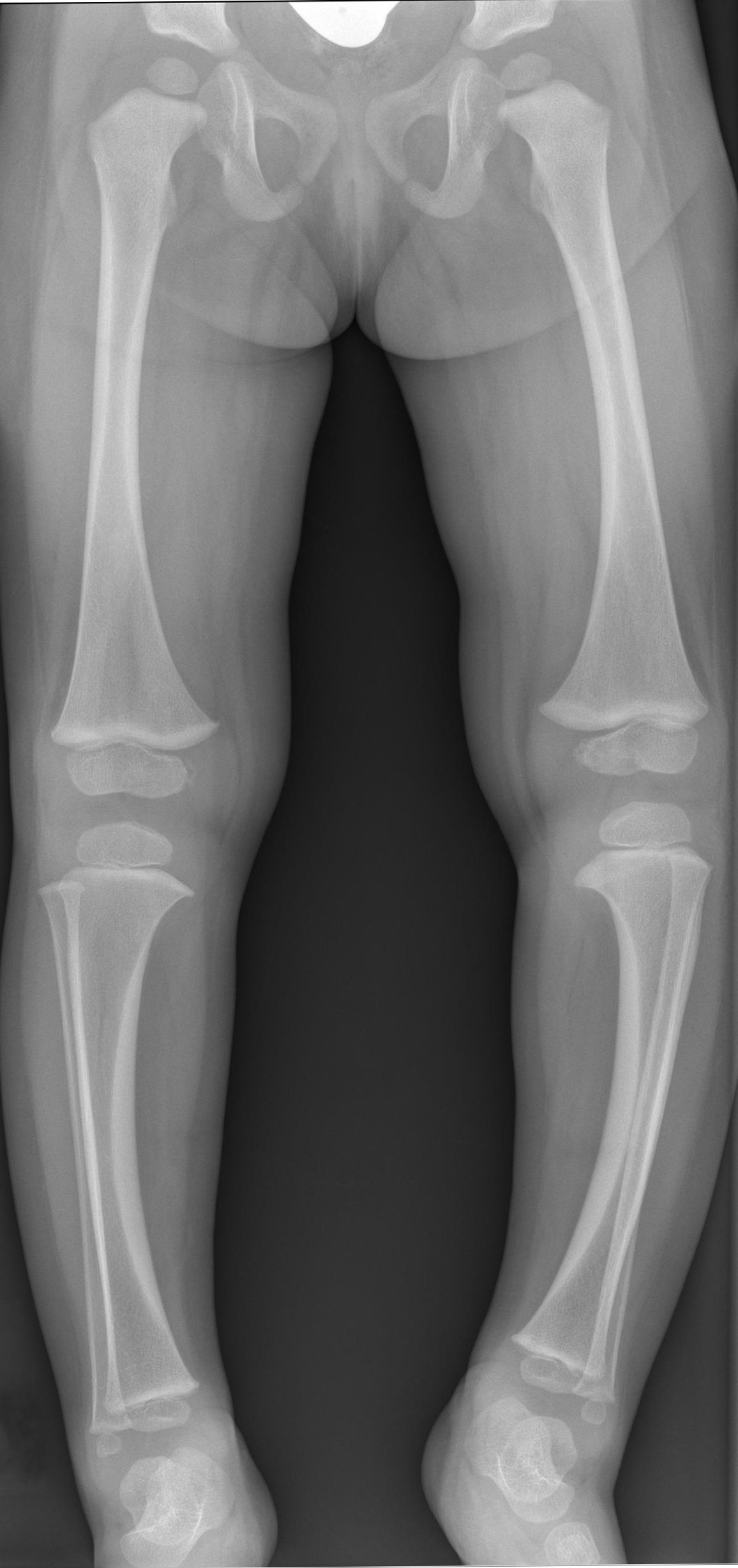 Standing anteroposterior radiograph showing bilateral proximal tibial varus, medial physeal irregularity and metaphyseal depression in Blount’s disease.