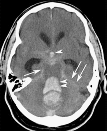 Axial non-contrast CT brain showing hyperdense acute blood within the subarachnoid spaces.