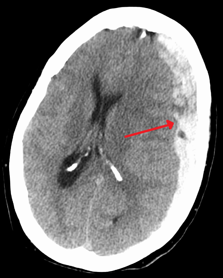 Axial non-contrast CT showing a large left frontoparietal subdural haematoma with ventricular compression and marked midline shift.