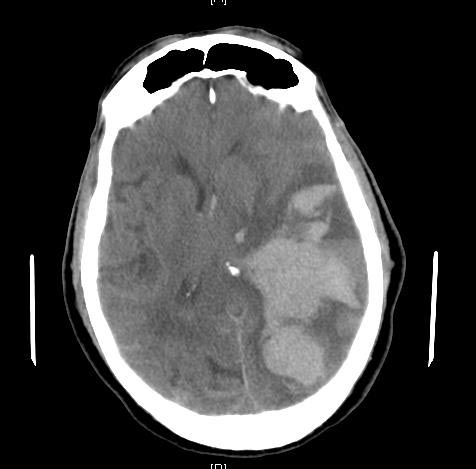 Axial CT demonstrating subfalcine herniation with displacement of midline brain structures beneath the falx.