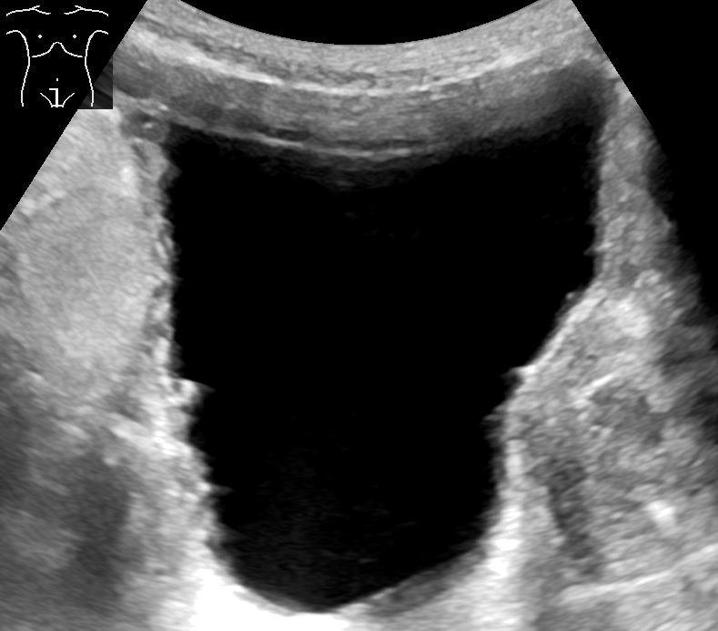 Ultrasound showing a distended urinary bladder with trabeculation of the bladder wall.