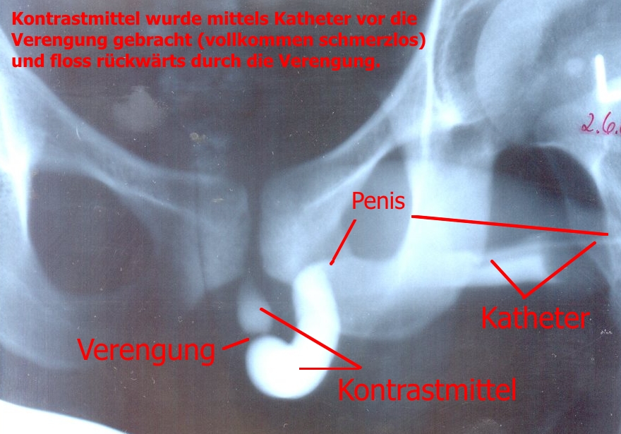 Retrograde urethrogram showing focal narrowing of the male urethra.