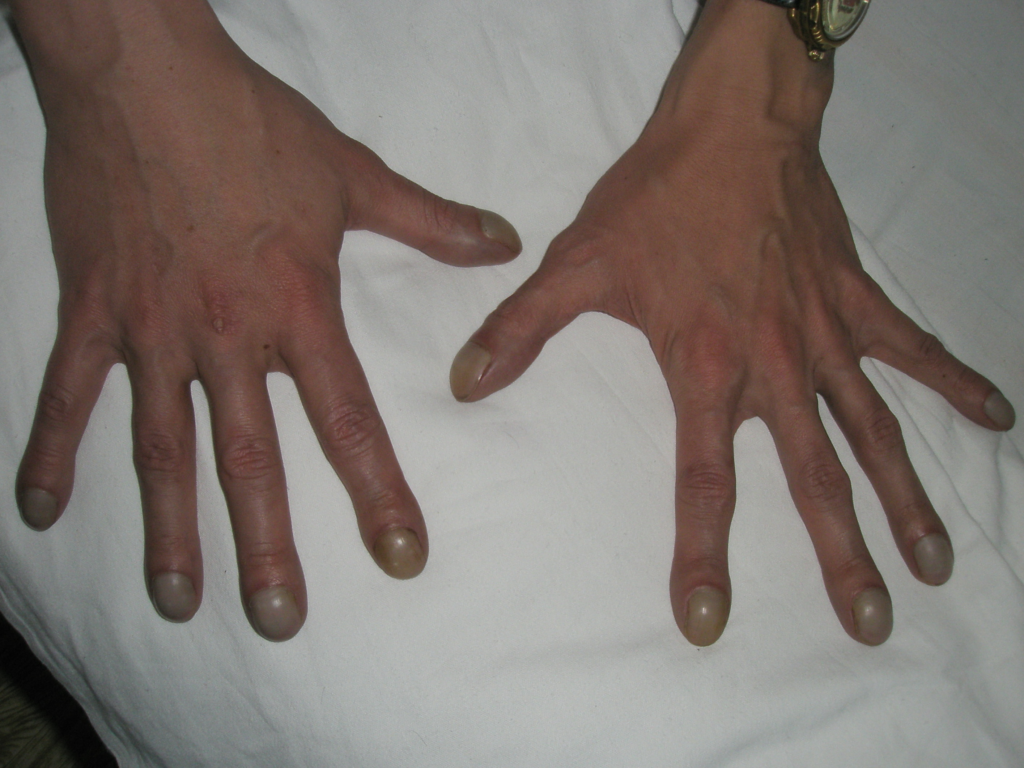 Both hands showing bulbous fingertips and increased nail curvature from digital clubbing