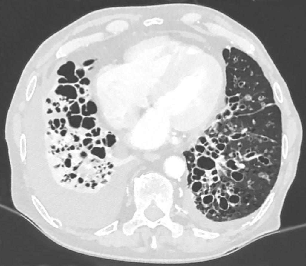 Axial chest CT demonstrating severe bilateral lower-lobe bronchial dilatation consistent with bronchiectasis