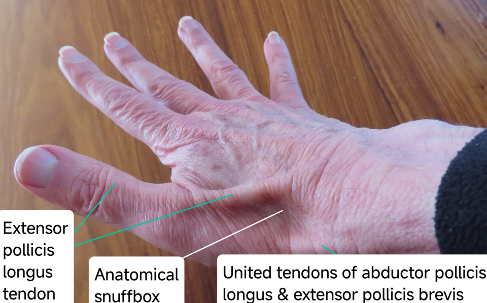 Anatomical snuffbox of the wrist with surrounding tendons labelled