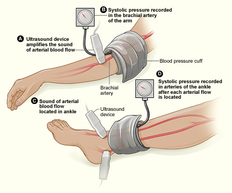 Illustration showing ankle-brachial index measurement using blood pressure cuffs and Doppler ultrasound