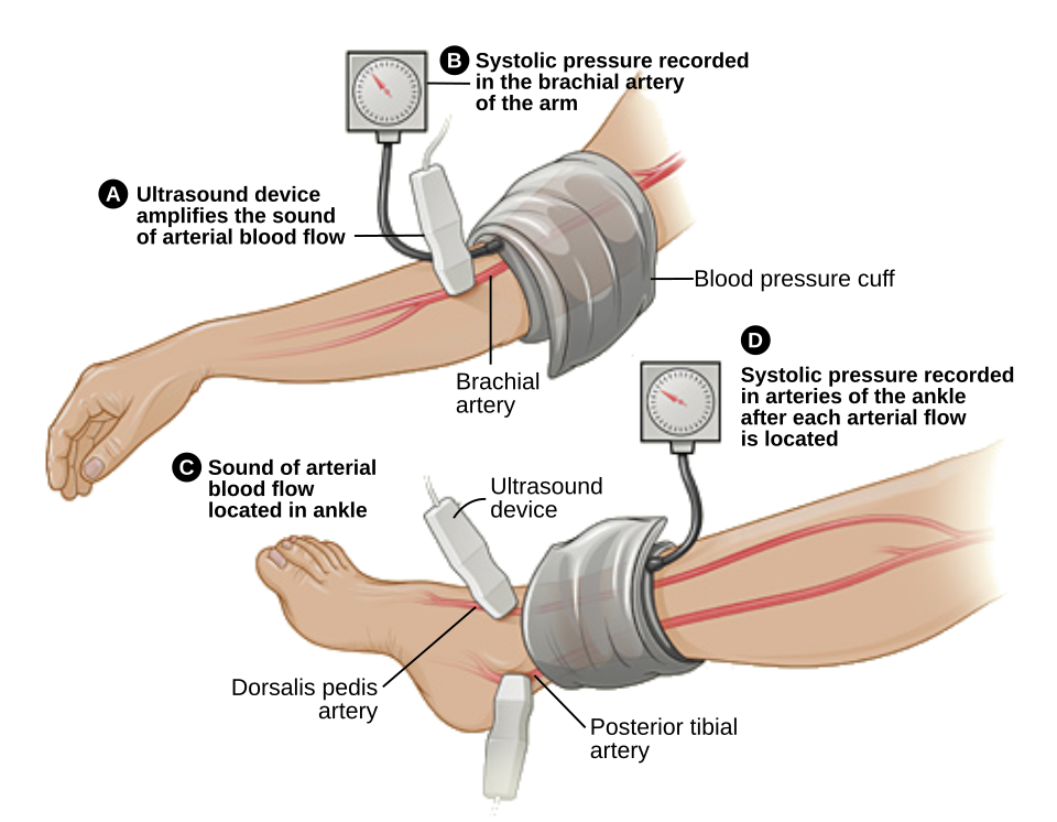 Diagram showing blood-pressure cuffs and Doppler assessment at the arm and ankle for ABI measurement.