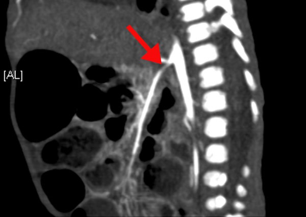 CT angiogram of the abdominal vessels with an arrow identifying stenosis of the superior mesenteric artery.