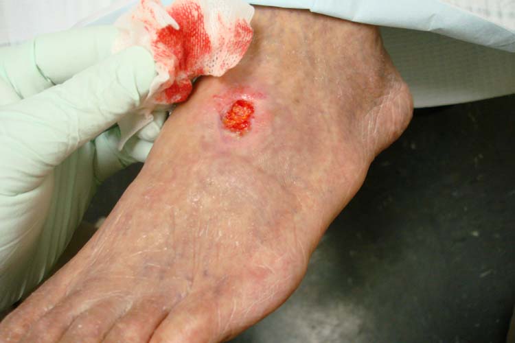 Clinical photograph of an arterial ulcer on the foot in severe peripheral arterial disease
