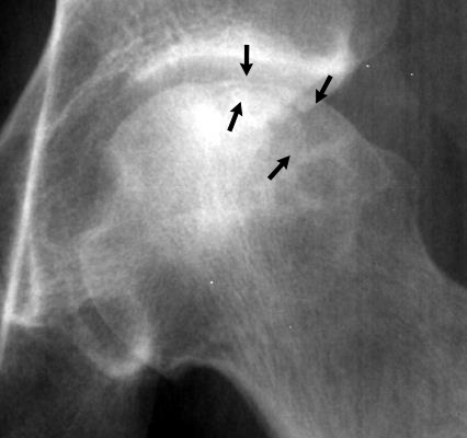 Hip X-ray showing the crescent sign of avascular necrosis of the femoral head