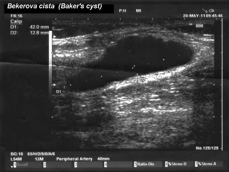 Longitudinal ultrasound image of a Baker cyst behind the knee