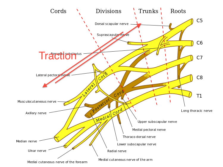 Diagram showing traction of the brachial plexus when the neck and shoulder are forcibly separated