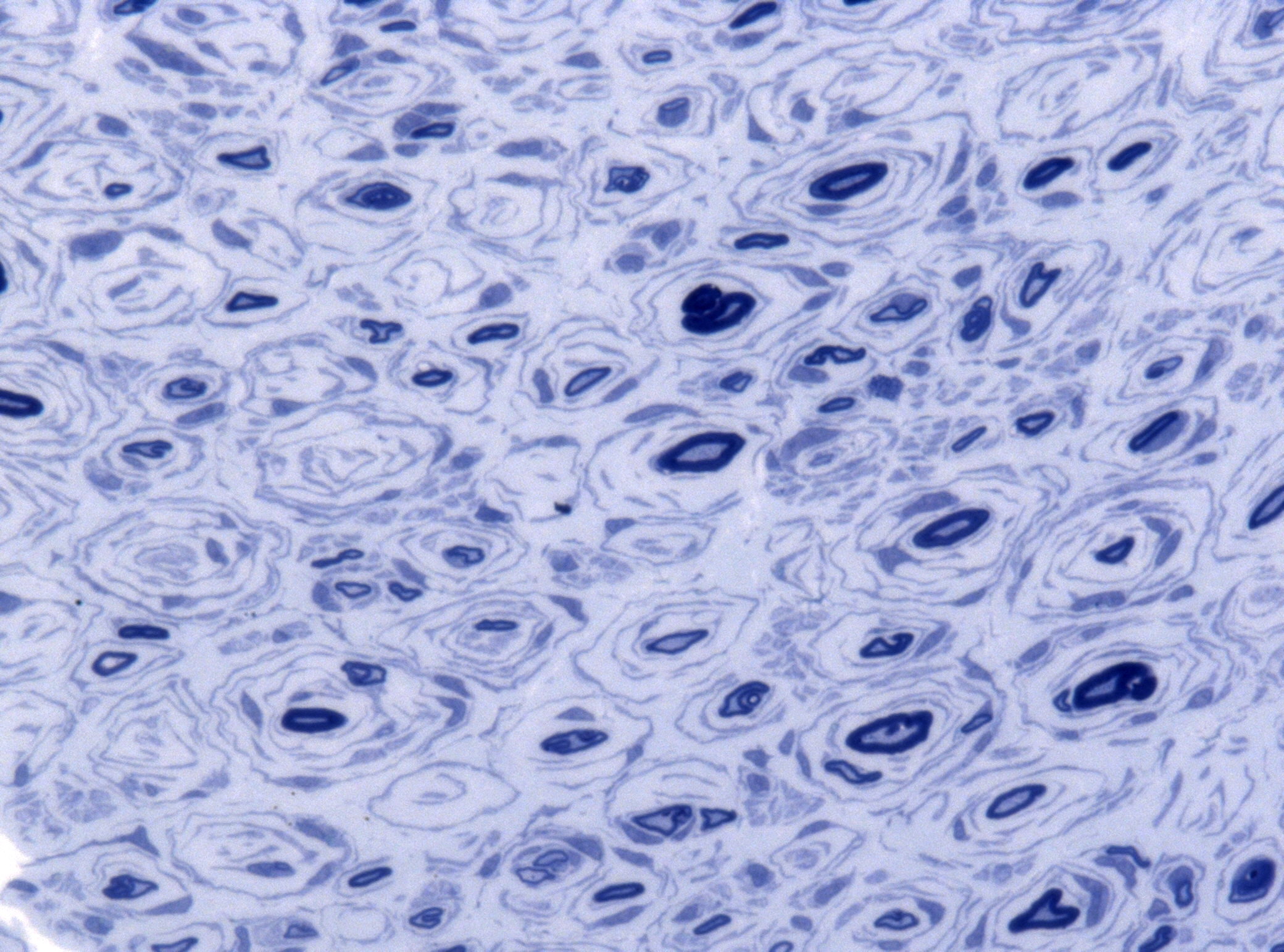 Semithin peripheral-nerve biopsy showing multiple concentric onion-bulb formations around nerve fibres.