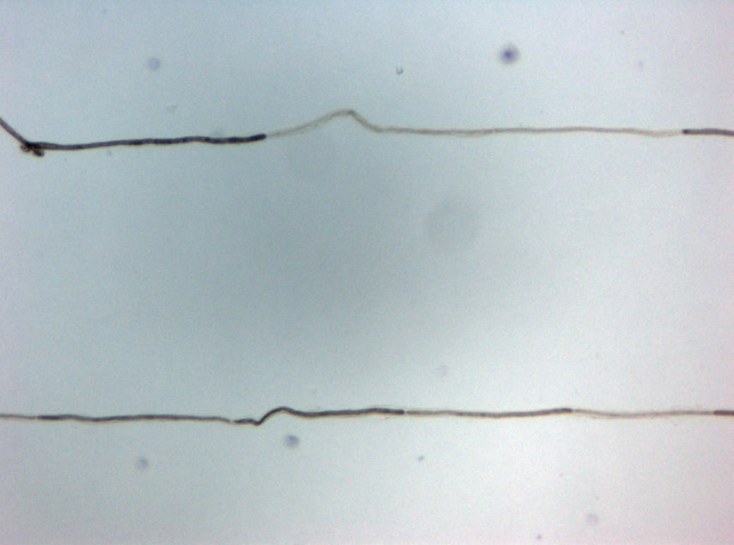 Teased peripheral nerve fibre showing focal loss of myelin along a nerve segment in CIDP.