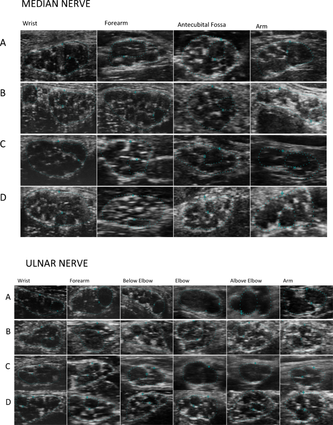 Four-panel nerve ultrasound comparison showing enlarged, swollen and hypoechoic fascicles in CIDP relative to other neuropathies and a healthy nerve.