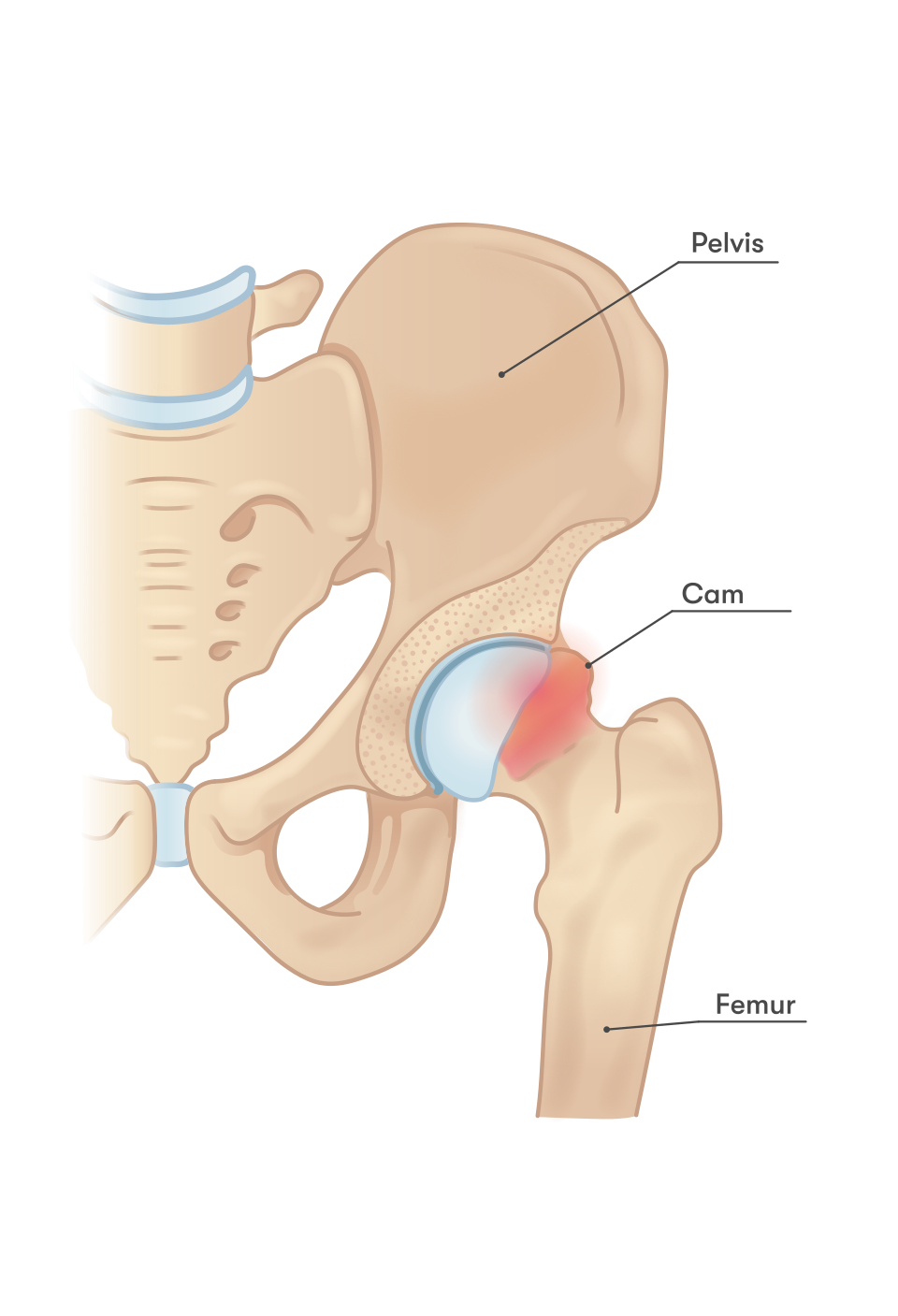 Medical diagram showing cam-type femoroacetabular impingement