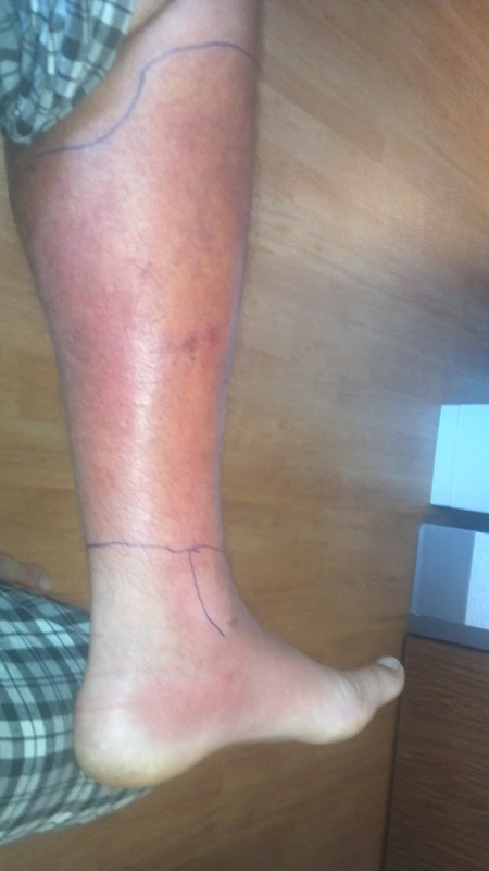 Clinical photograph showing cellulitis of the lower leg