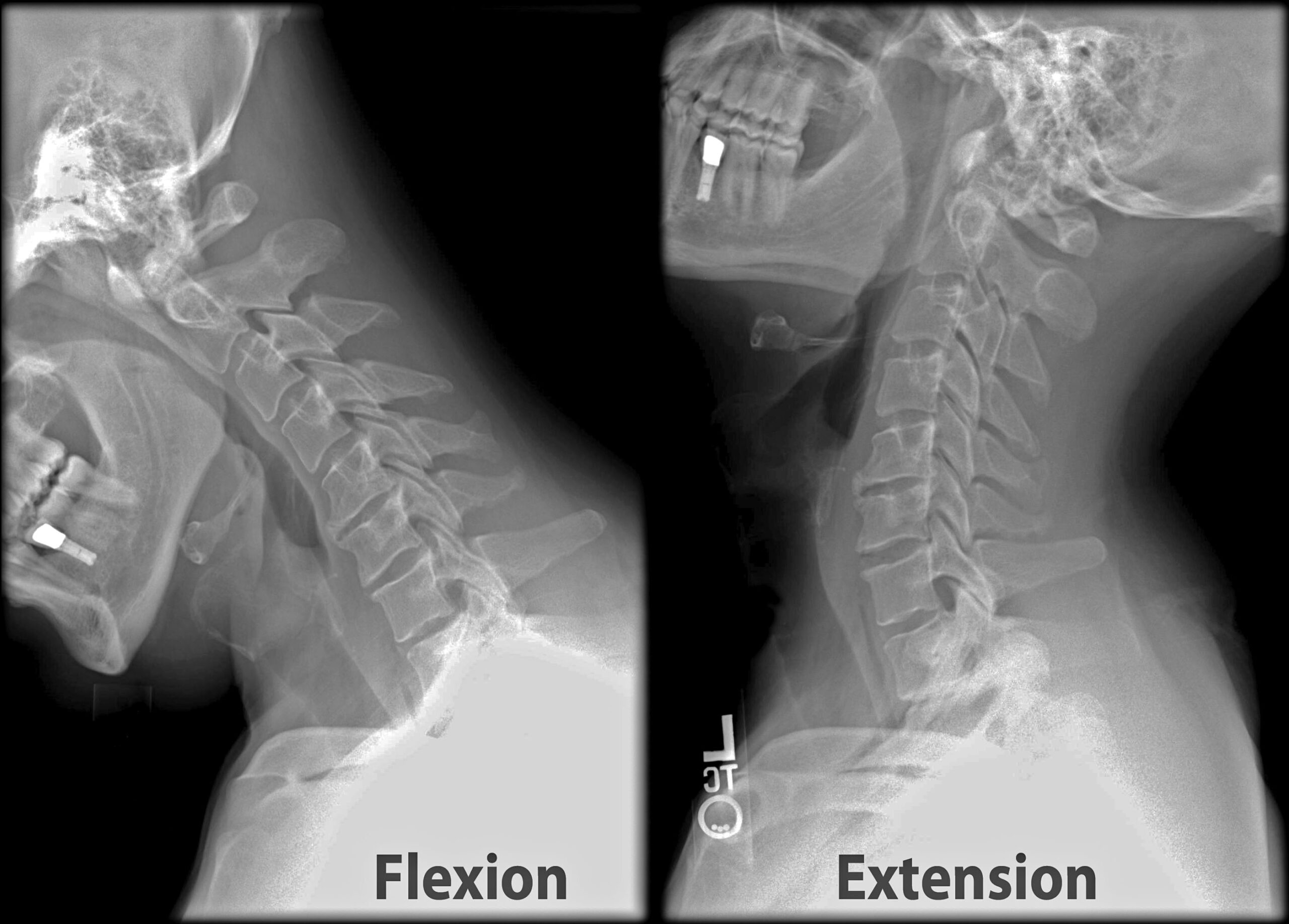 Paired lateral cervical radiographs obtained in flexion and extension showing maintained alignment