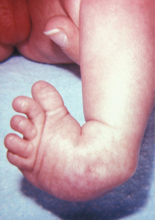 Medical illustration showing the abnormal inward and downward alignment of a clubfoot.
