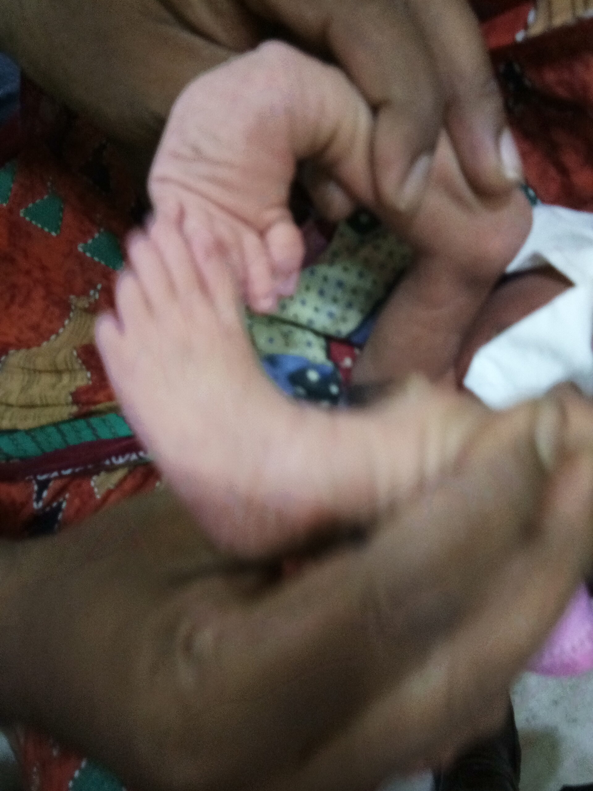 Close-up of an infant foot affected by congenital talipes equinovarus before treatment.
