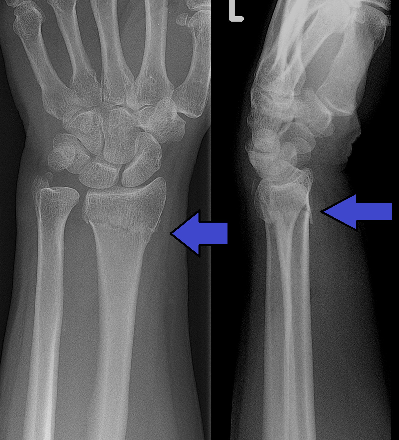 Wrist X-rays showing a Colles fracture of the distal radius
