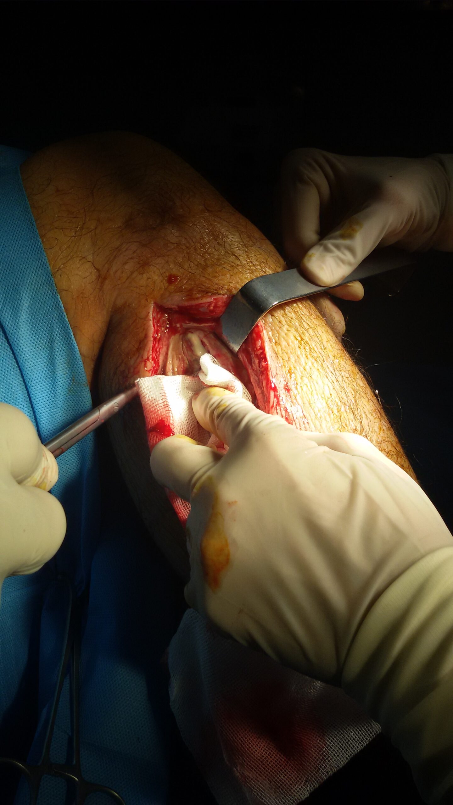 Clinical photograph showing fasciotomy performed for acute lower leg compartment syndrome