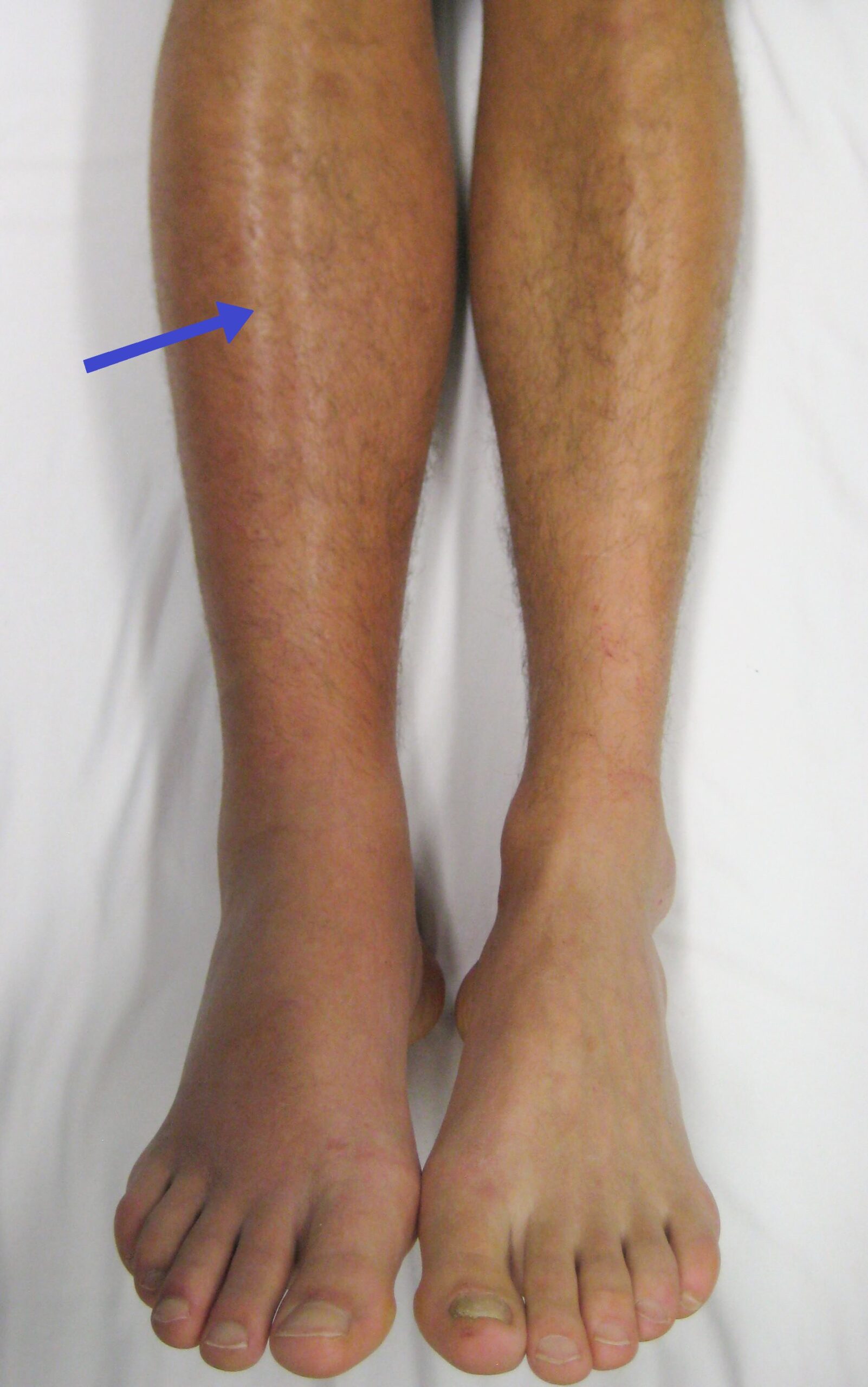 Clinical photograph showing swelling and erythema of the right leg caused by deep vein thrombosis