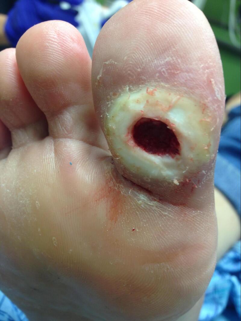 Clinical photograph of a diabetic foot ulcer