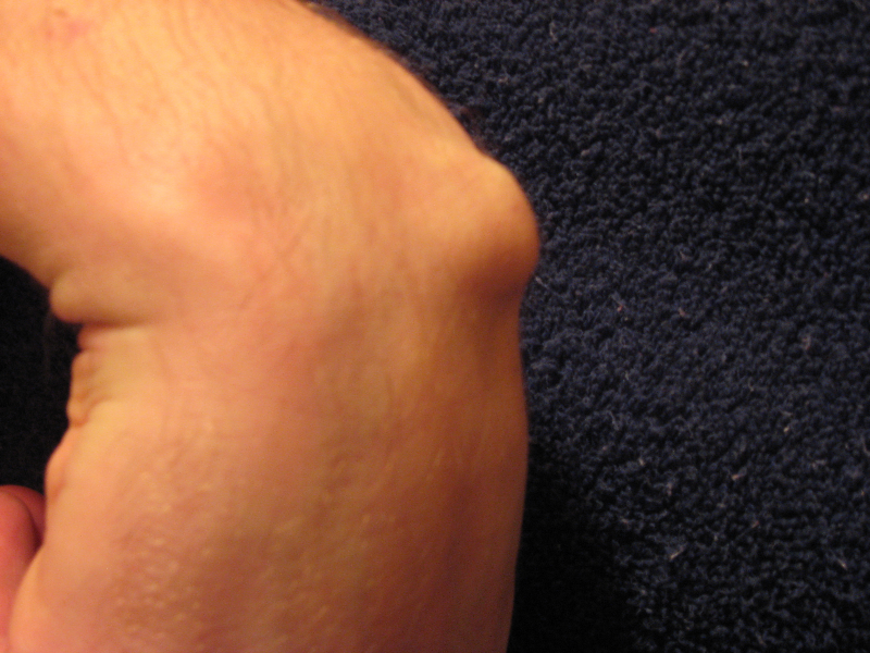 Clinical photograph of a dorsal wrist ganglion cyst
