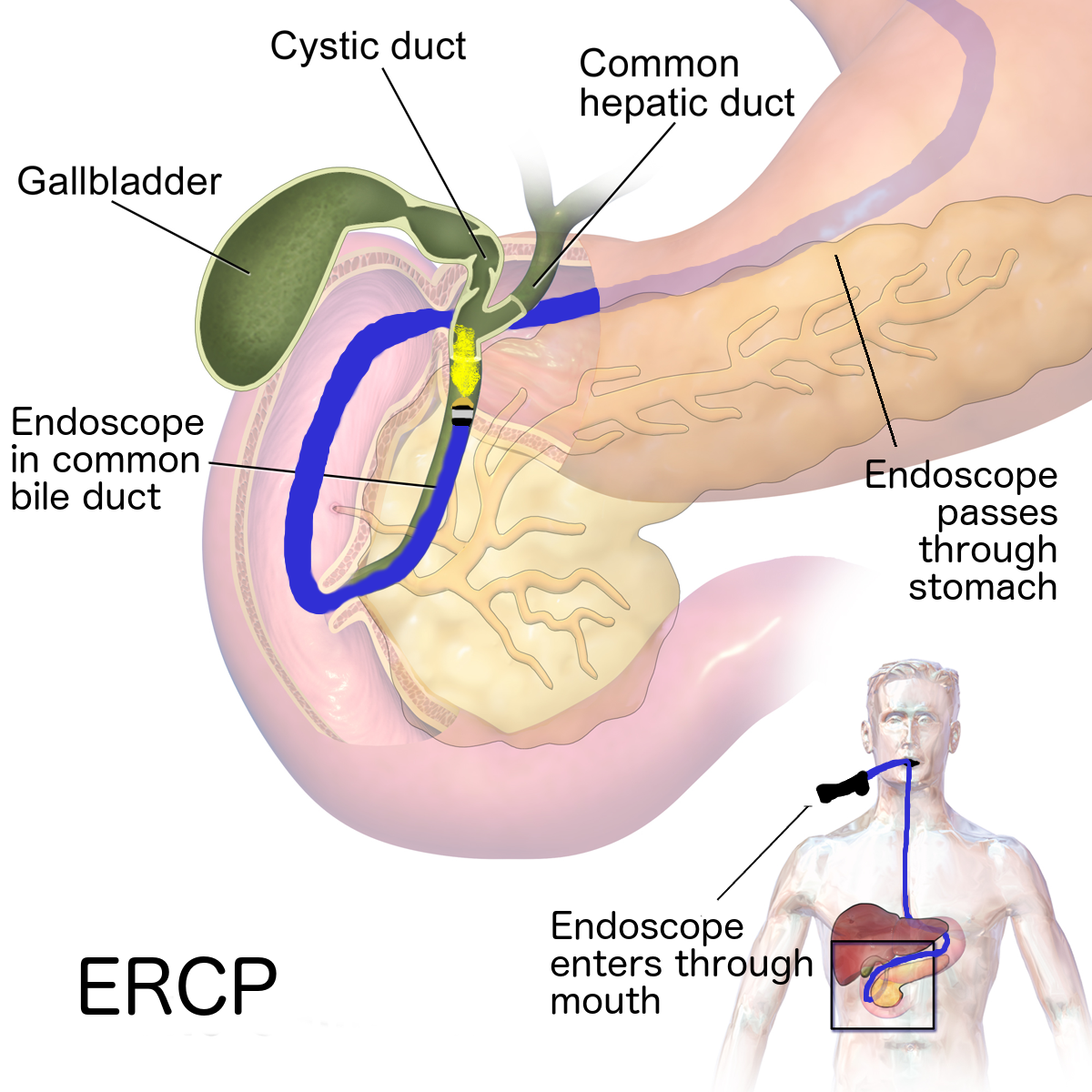 Diagram showing an endoscope in the duodenum with a catheter entering the biliary duct during ERCP.