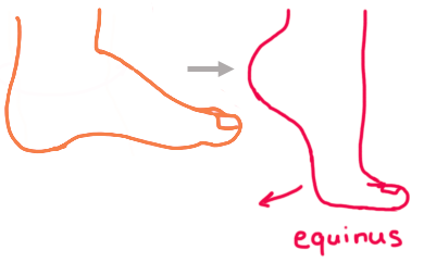 Illustration showing a foot held in plantar flexion due to equinus deformity.