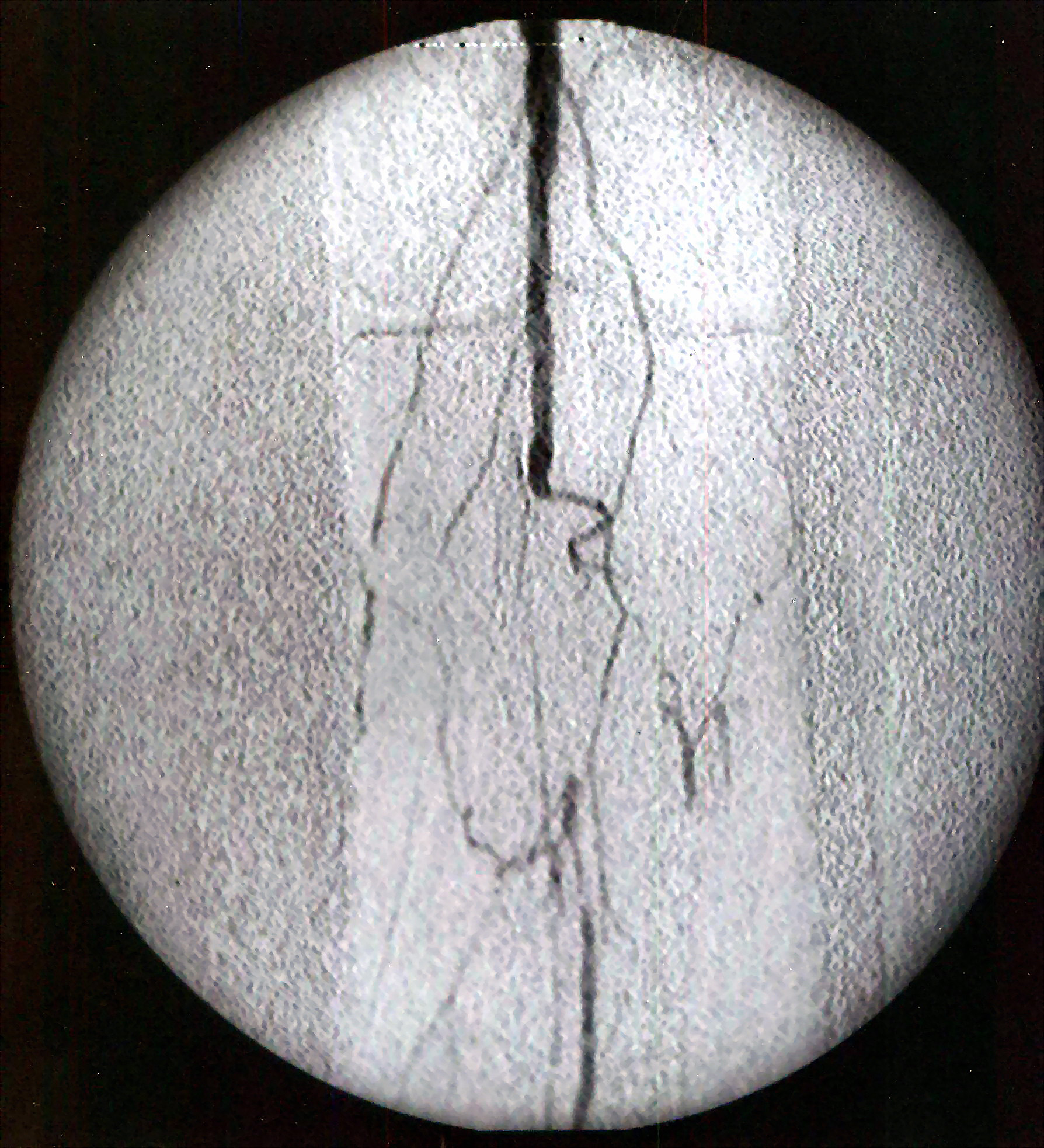 Femoral angiogram showing contrast outlining the lower-limb arterial circulation.