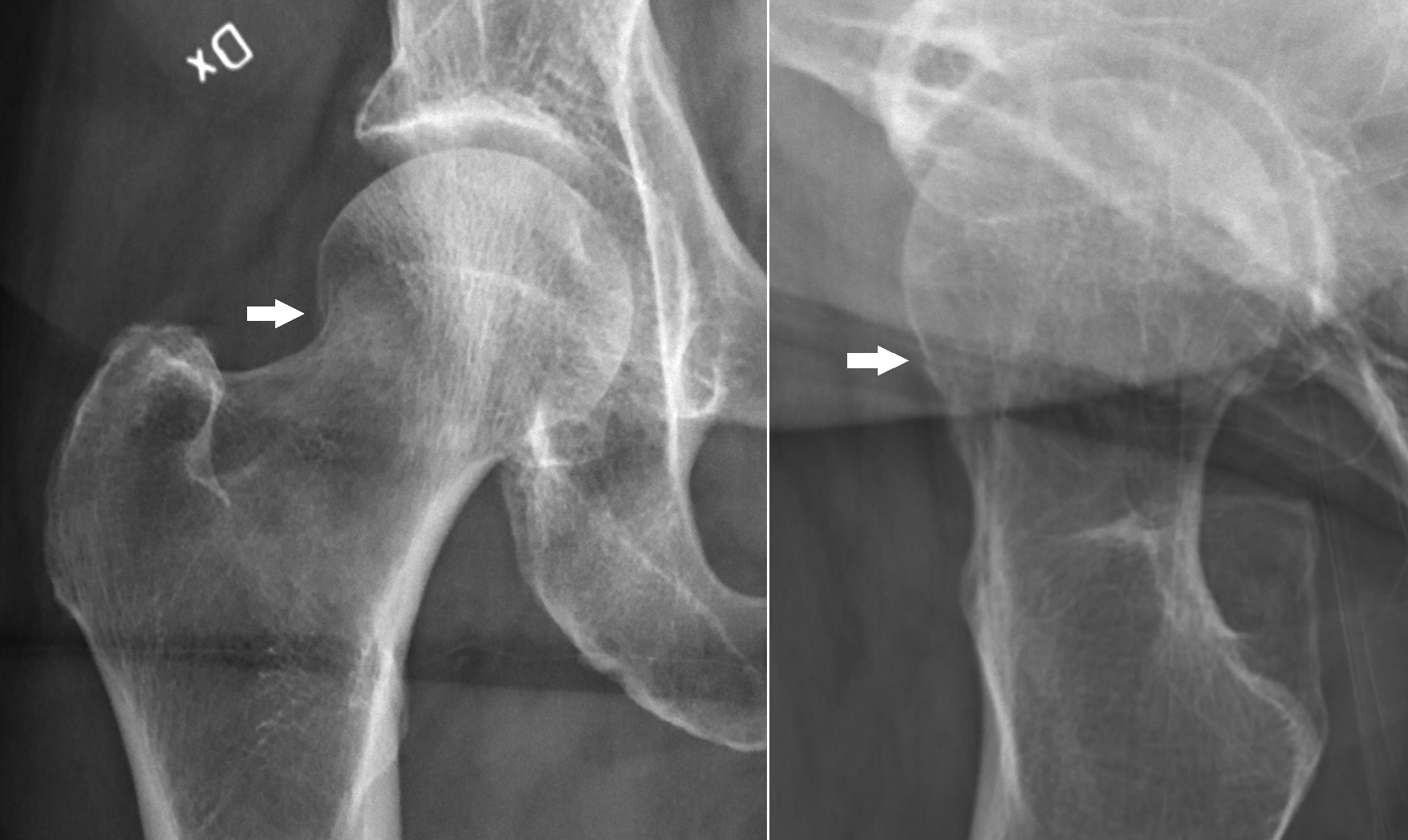 Annotated X-rays showing a mildly compressed femoral neck hip fracture