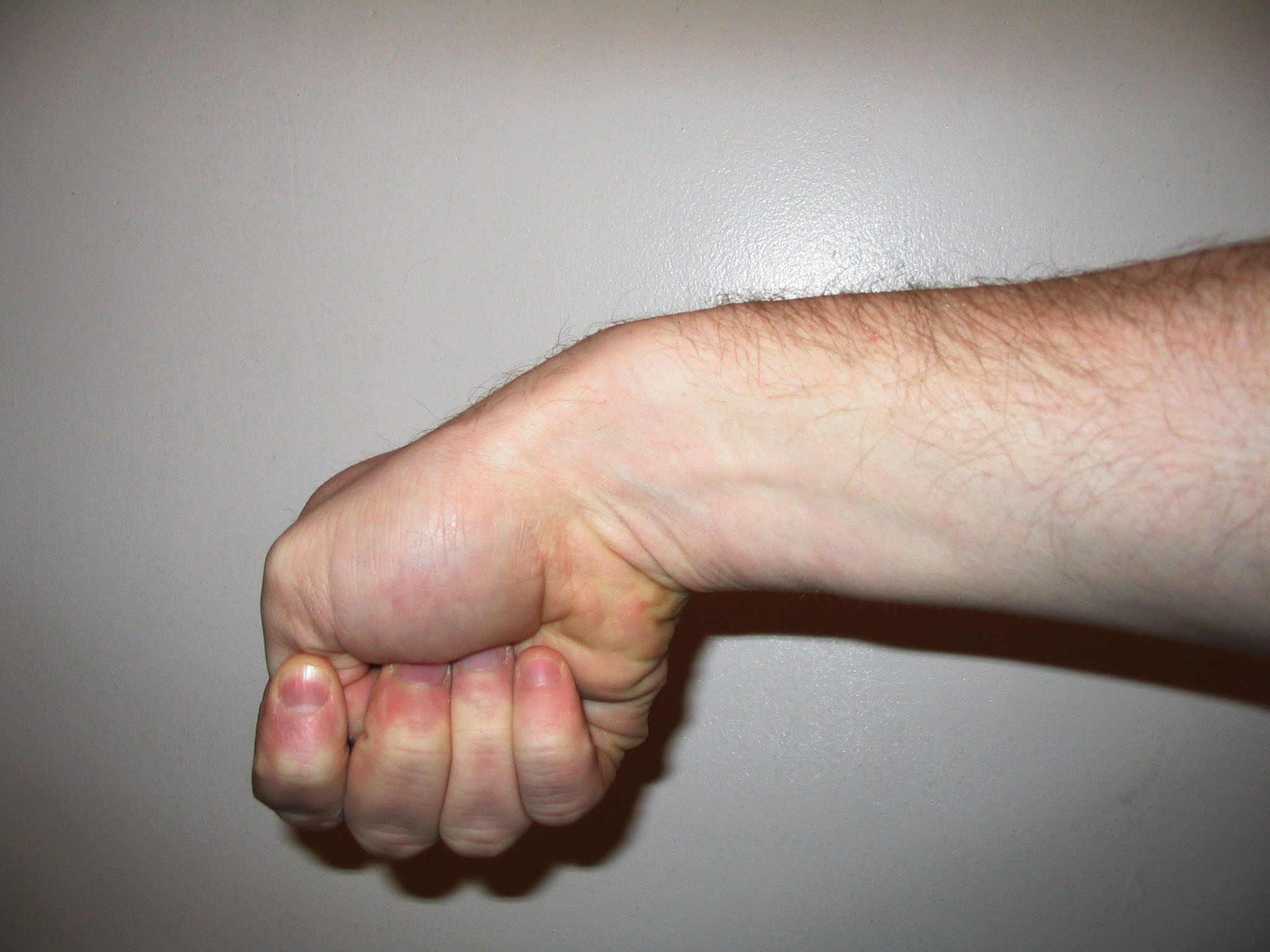 Finkelstein test for De Quervain tenosynovitis