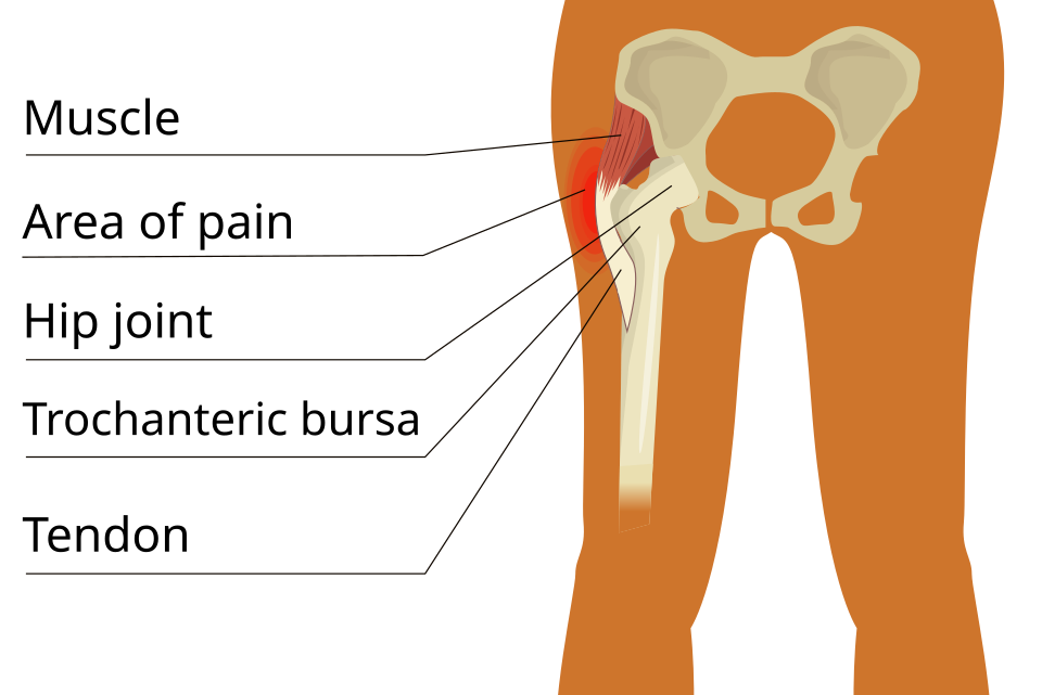 Diagram showing the lateral hip structures involved in greater trochanteric pain syndrome