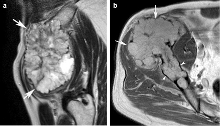 MRI of high-grade right iliac chondrosarcoma showing cortical destruction, tumour necrosis and extraosseous soft-tissue mass