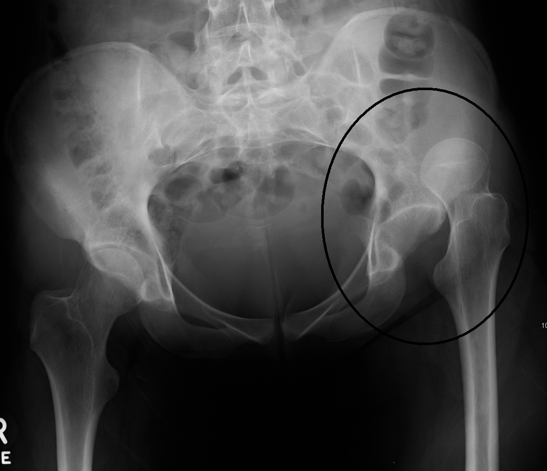 Pelvic X-ray showing a traumatic dislocation of the hip