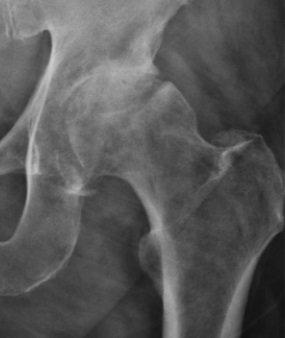 Hip X-ray showing osteoarthritis with joint space loss and degenerative change