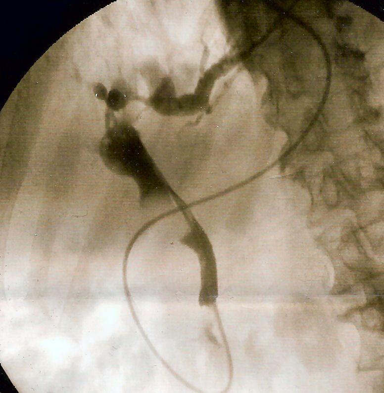 ERCP fluoroscopic image showing a filling defect from an impacted distal common bile duct stone.