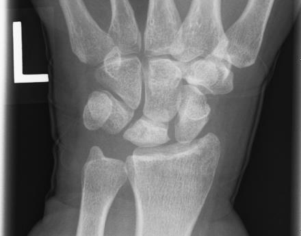 Wrist X-ray showing Kienbock disease involving the lunate