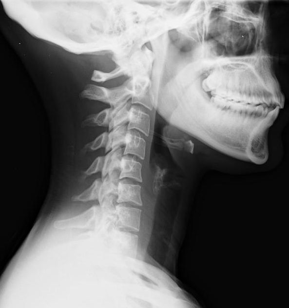 Lateral cervical spine radiograph showing straightening and loss of the normal cervical lordosis