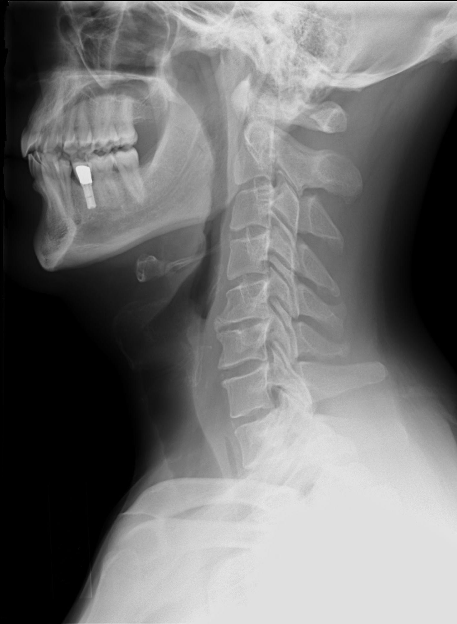 Lateral cervical spine radiograph showing vertebral alignment and degenerative change at C5–6