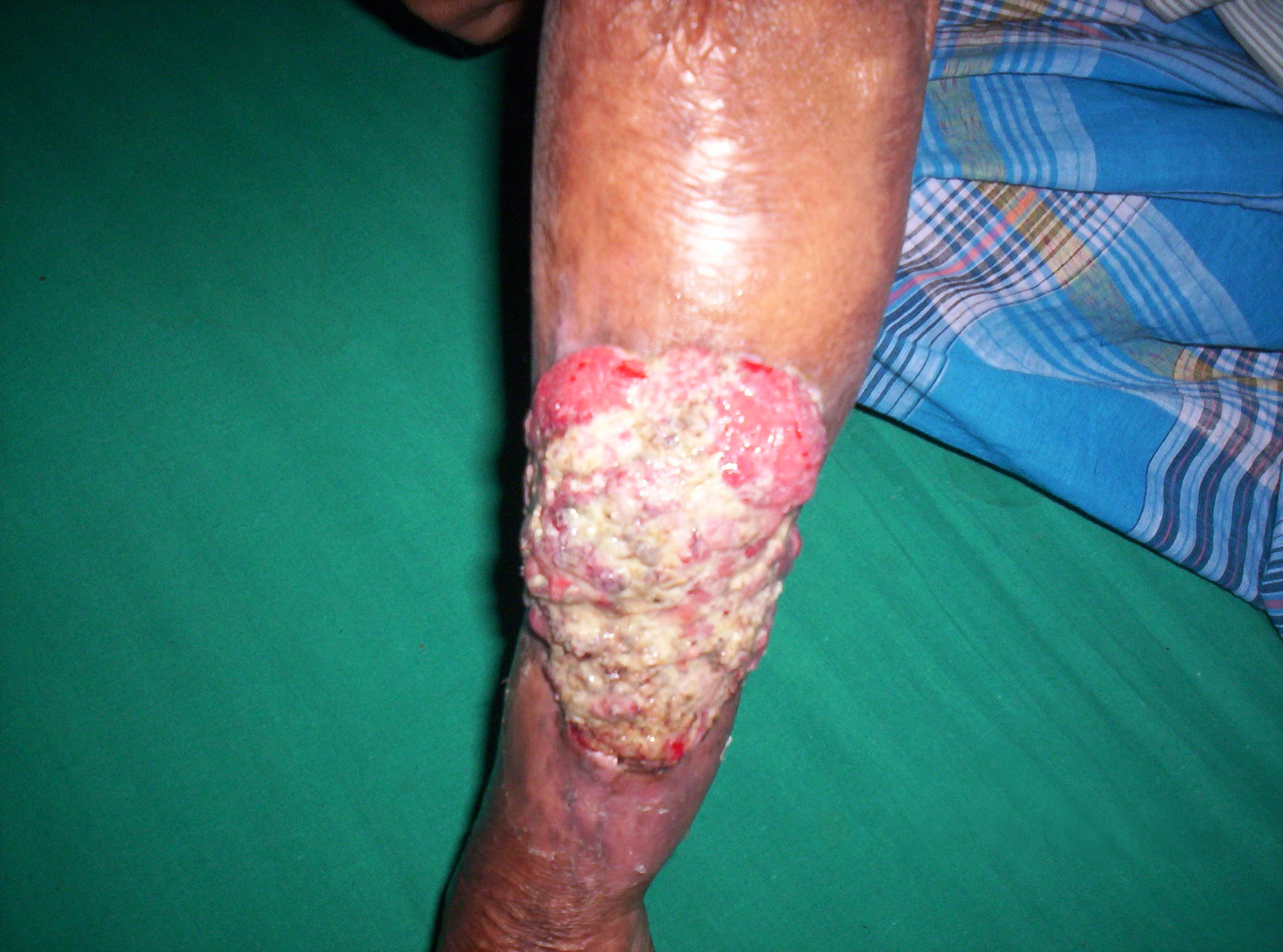 Clinical photograph of a Marjolin ulcer arising in a chronic scar