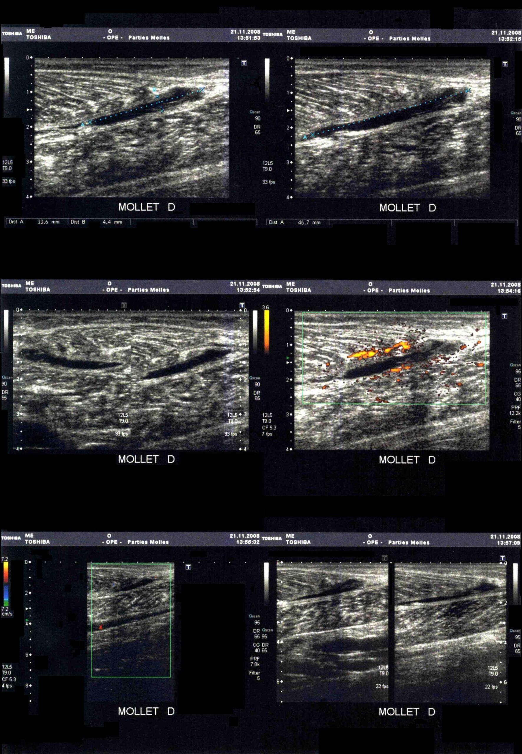 Ultrasound image showing a tear of the medial gastrocnemius muscle